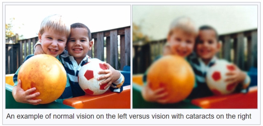cataract-vision